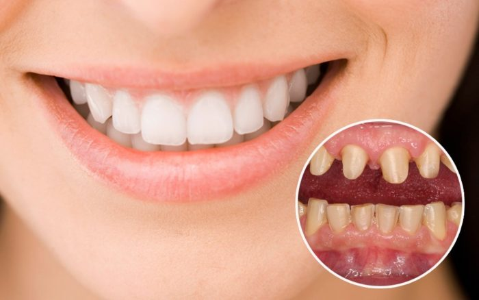 Bọc răng sứ có bền không ? 10 điều bạn cần lưu ý trước khi bọc răng sứ