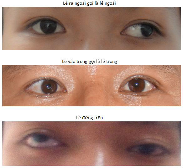4 điều cơ bản bạn nên biết về mắt lác