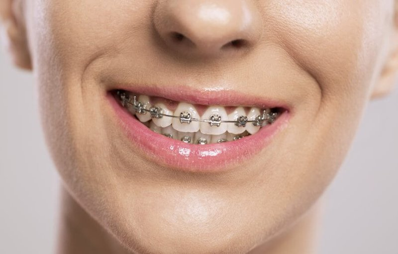 Nhổ răng để niềng có nguy hiểm không ? Một số lựa chọn thay thế nhổ răng trước khi niềng